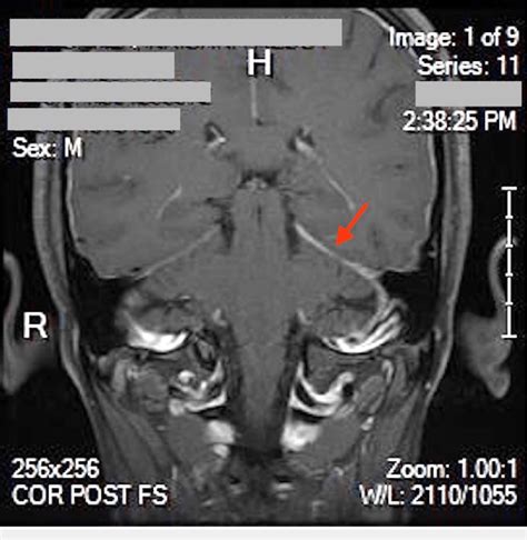 Mri Brain Without Contrast Showing Asymmetric Tentorial Enhancement