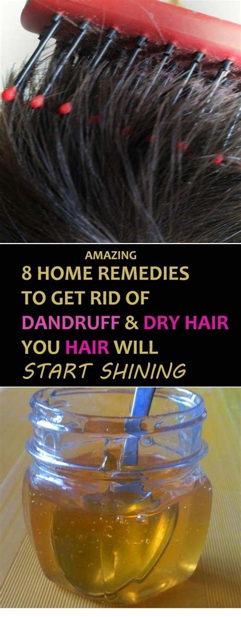 8 Best Home Remedies For Dandruff And Itching Scalp