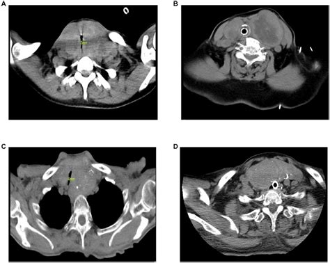Preoperative Cervical CT Images Of 4 Cases A Case 1 The Size Of The