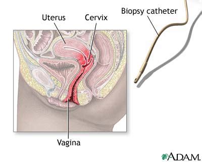 Endometrial Biopsy MedlinePlus Medical Encyclopedia Image 79116 Hot