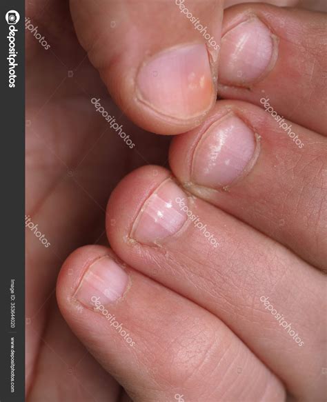 White Spots On Nails Due To Zinc Deficiency My Bios