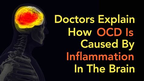 Doctors Explain How Ocd Is Caused By Inflammation In The Brain