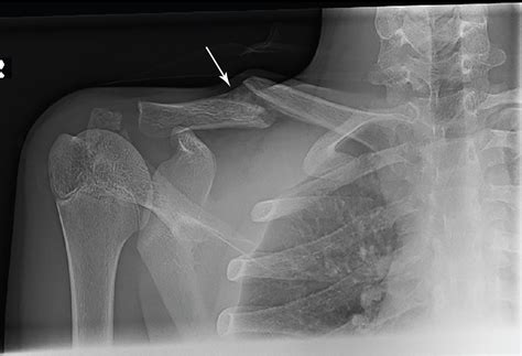 In Pieces Clavicle Fracture Radiology Key