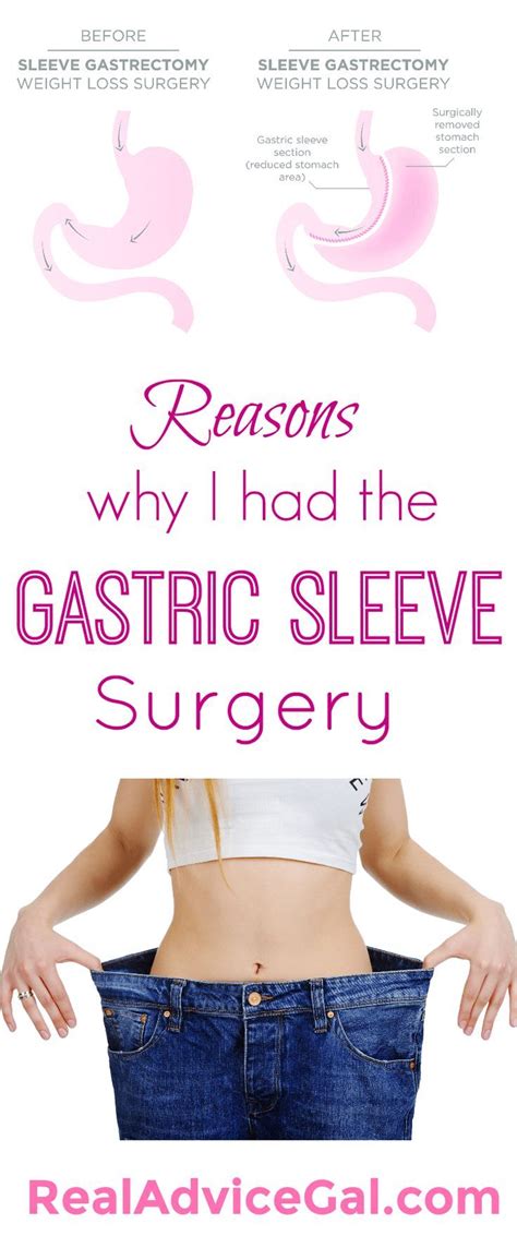 Why I Had The Gastric Sleeve Surgery Real Advice Gal Gastric Sleeve Surgery Gastric Sleeve