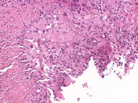 Epithelioid mesothelioma is a form of the asbestos cancer that develops in the epithelial cells. Epithelioid mesothelioma - Case 297 | 75 year old non ...