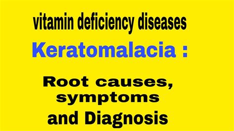 Keratomalacia Vitamin Deficiency Diseases Youtube