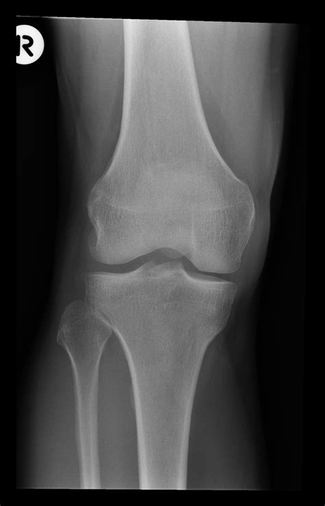 Knee Lipohemarthrosis Due To Tibial Plateau Fracture Image