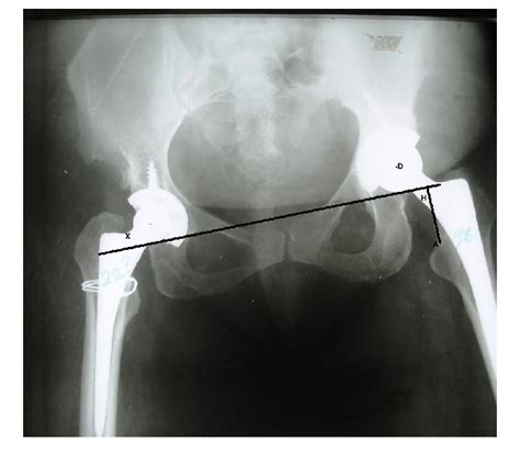 Anteroposterior Pelvic Radiograph Of A Patient After Bilateral Hip