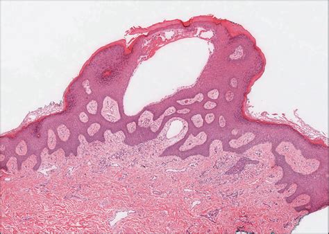 Vesicular Lesions On The Vulva—quiz Case Cervical Cancer Jama