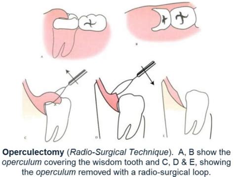 Pericoronitis Complete Guide Types And Functions Idw