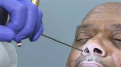 Man’s Runny Nose Turns Out To Be Leaking Brain Fluid Rare