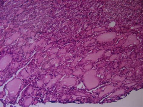 Neoplasias De Tejido Fibroso