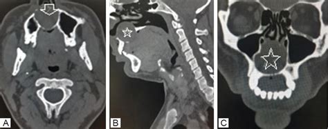 Non Odontogenic Hard Palate Cysts With Special Reference To