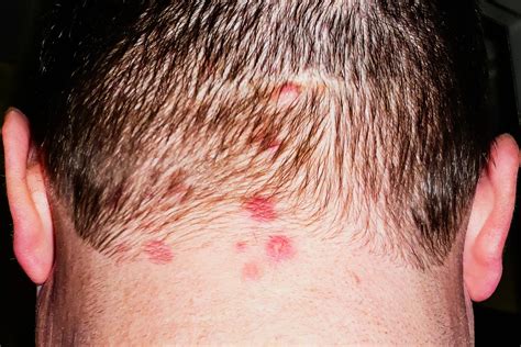 Dermatitis Herpetiformis Causes Symptoms Treatment