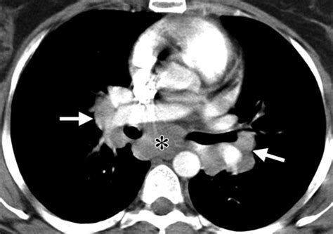 Pulmonary Sarcoidosis Typical And Atypical Manifestations At High