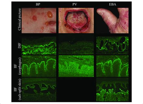 See the separate leaflet called bullous pemphigoid. | Clinical and immunopathological characteristics in ...