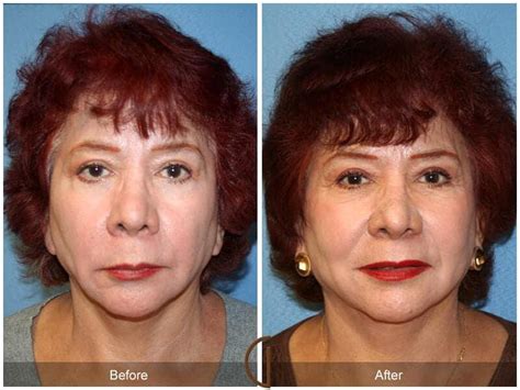 Facial Fat Grafting Before And After Photos Patient 18 Dr Kevin Sadati