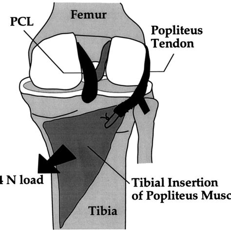 The Popliteus Complex Showing The Muscle And The Tendon The Lateral