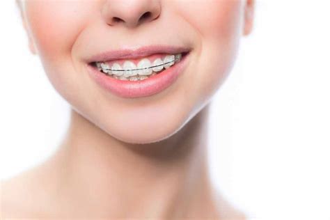 How Do Braces Work To Fix Your Smile