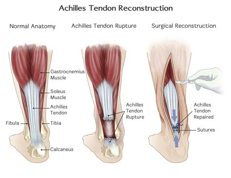 Patients who have undergone arthroscopic debridement of achilles tendon surgery can expect to be given pain killers and to. Achilles tendon rupture | Symptoms of the Achilles tendon ...