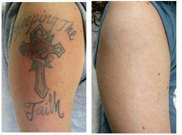 The safest and most effective way of removing tattoos is through laser removal. Pin on Tattoo Removal Before and After