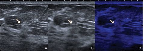 High Frequency Breast Ultrasound For The Detection Of