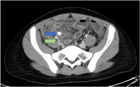 Ct Scan Upon First Presentation Showing Signs Of Acute Appendicitis