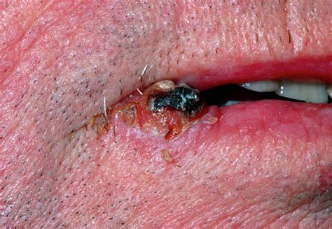 Squamous Cell Carcinoma Of The Lip In A Man Photograph By Dr P Marazzi