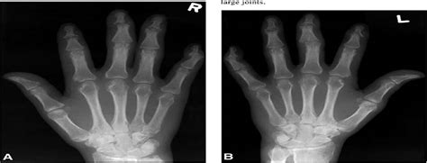 Imaging Of Psoriatic Arthritis Contemporary Diagnostic Radiology
