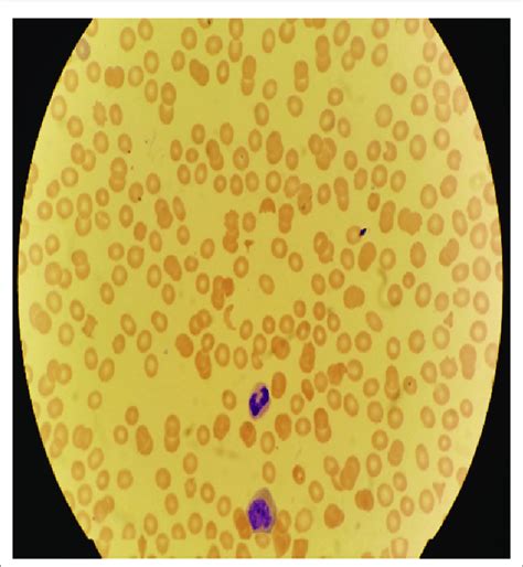 Peripheral Smear Showed Schistocytes Normochromic Normocytic Anemia