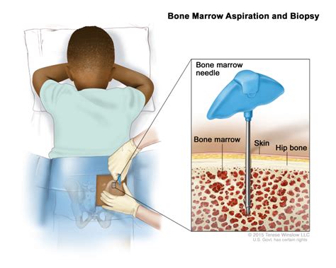 Figure Bone Marrow Aspiration And Biopsy Pdq Cancer Information
