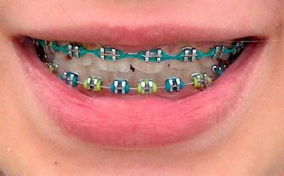 Teeth braces or dental braces (orthodontic braces/braces) are used to align and straighten teeth. make your own braces: braces picker color lol