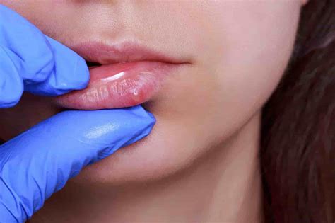 Causas del herpes labial y cómo prevenir su aparición