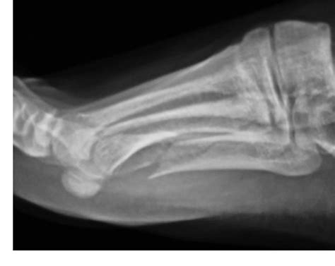 Figure 1 From Surgical Management Of Fifth Metatarsal Diaphyseal