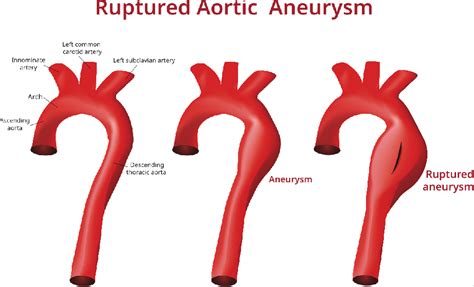 Aorta Aneurysm Sizes