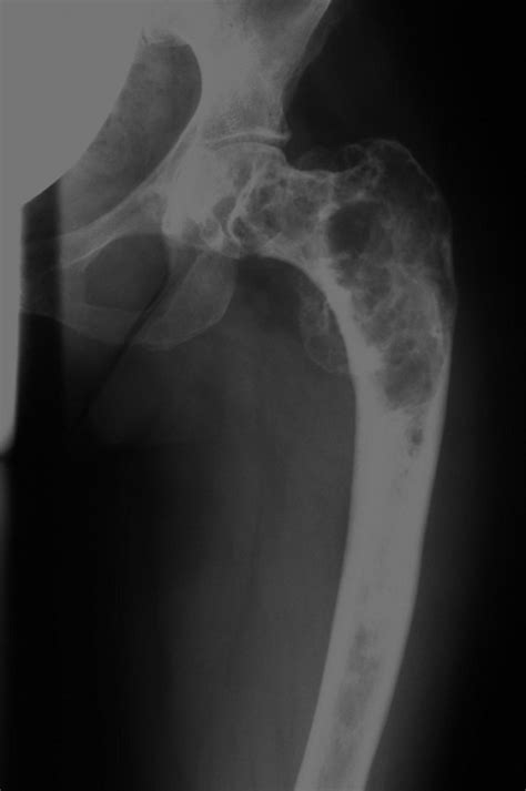 X Ray Of The Left Femur Anteroposterior Plain Film Of Open I