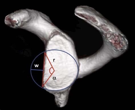 Open Versus Arthroscopic Latarjet Procedure For The Treatment Of