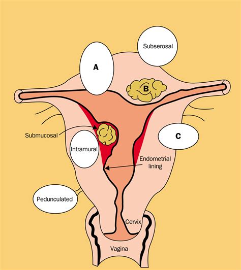 Uterine Fibroids The Lancet