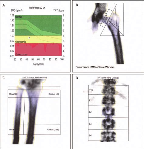 Bone Mineral Density Bmd In Male Workers A Osteoporosis Pattern