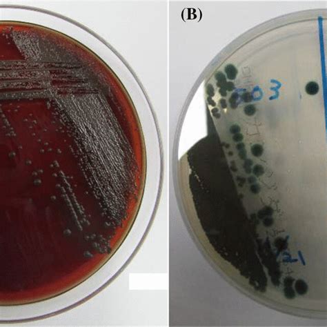 Ecthyma Gangrenosum Caused By Pseudomonas Aeruginosa Is A Neutropenic