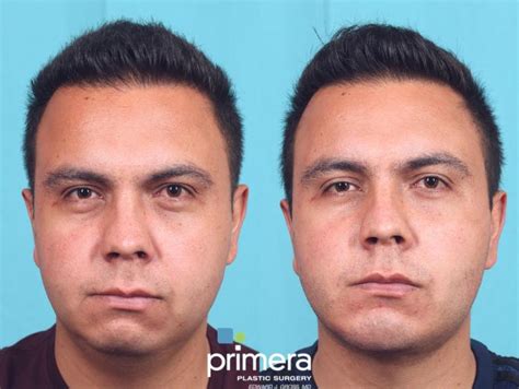 Buccal Fat Cheek Fat Removal And Chin Implant In Orlando Florida