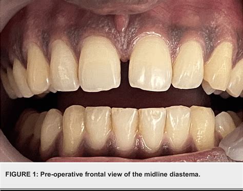 Figure 1 From Management Of Midline Diastema In A Young Adult With
