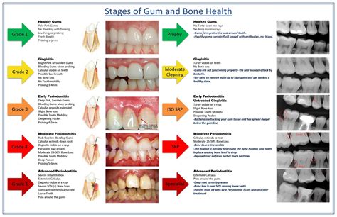 Dtlc Stages Of Gum And Bone Health Dental Tlc