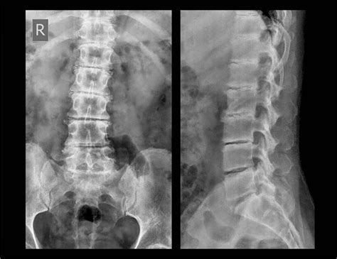 Lumbar Spine 3 Buyxraysonline