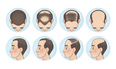 Male Pattern Baldness Treatment In Jaipur Hair Loss Treatment