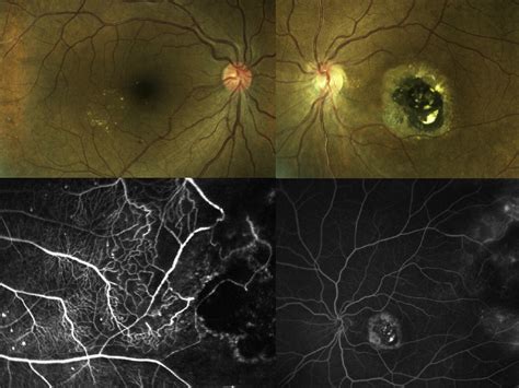 Current Management Of Coats Disease Survey Of Ophthalmology