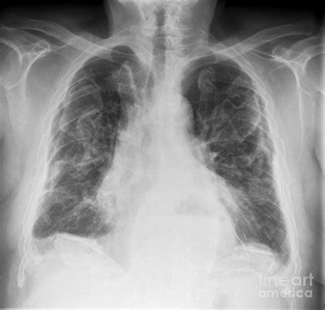 Asbestosis X Ray Photograph By Science Photo Library