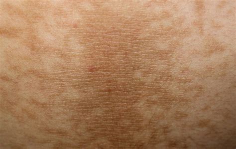 A Closer Look At Different Diabetic Rash Types And Other Skin Conditions
