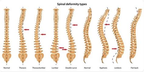 Spine Deformity Types Causes And Treatments Sattvik Spine Spine