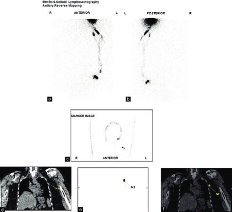 Lymphoscintigraphy Images Of A Patient With Carcinoma Left Breast